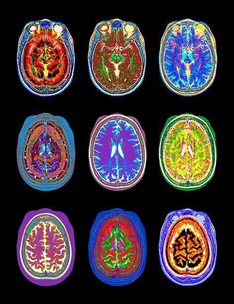 Those with an extreme decline in animal-based protein intake had a 48% higher risk of cognitive impairment